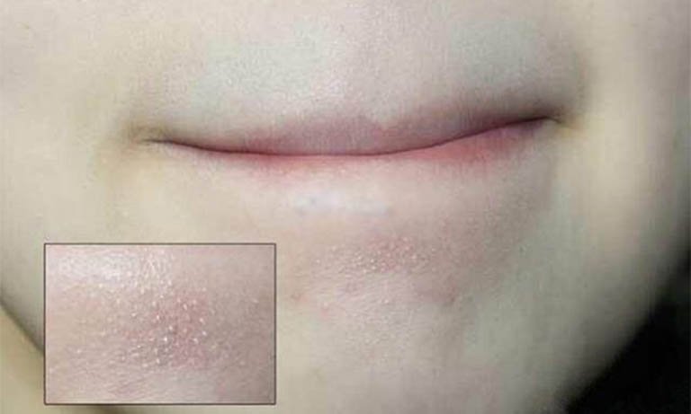 Mụn cám là gì? Nguyên nhân gây có thể mụn cám là gì?